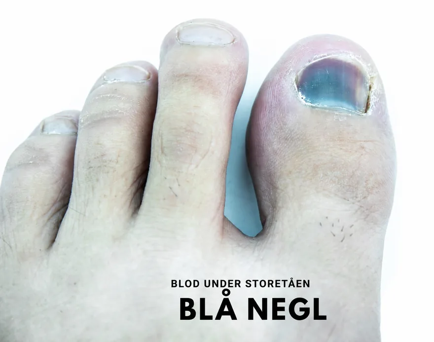 Storetå med kraftig blå negl
