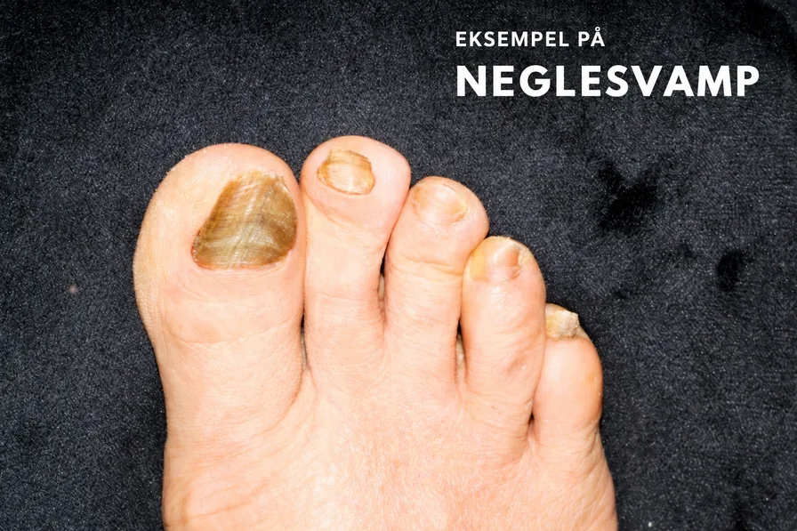 Neglesvamp på flere tæer, højre fod