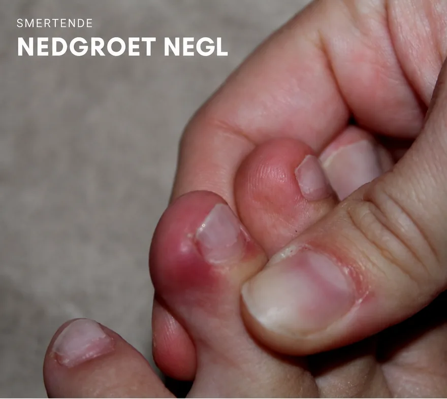 Smertende nedgroet negl med betændt tå